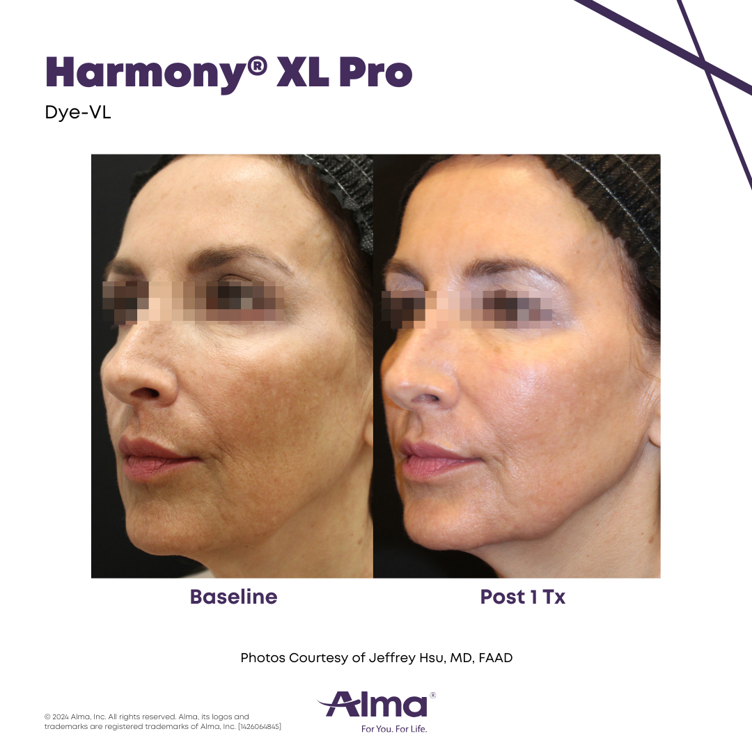 Before and after sun damage reduction with the Alma Harmony XL Pro at APMUC, Orlando, Florida. Patient result courtesy of Jeffrey Hsu, MD, FAAD / Alma.