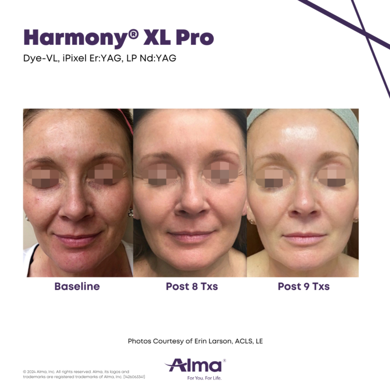 Before and after facial rejuvenation with the Alma Harmony XL Pro at APMUC, Orlando, Florida. Patient result courtesy of Erin Larson, ACLS, LE / Alma.