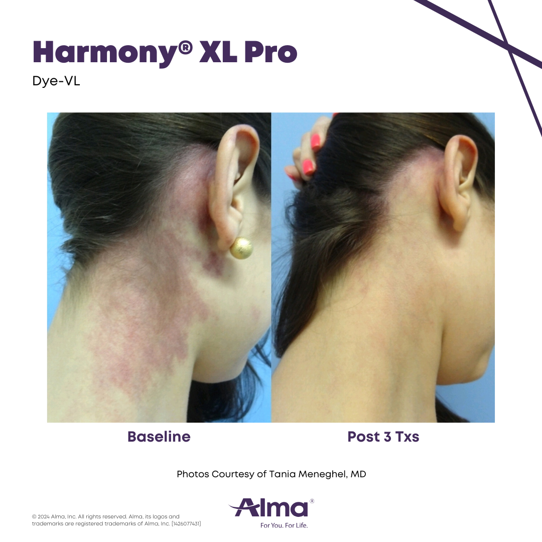 Before and after vascular lesion treatment with the Alma Harmony XL Pro at APMUC, Orlando, Florida. Patient result courtesy of Tania Meneghel, MD / Alma.