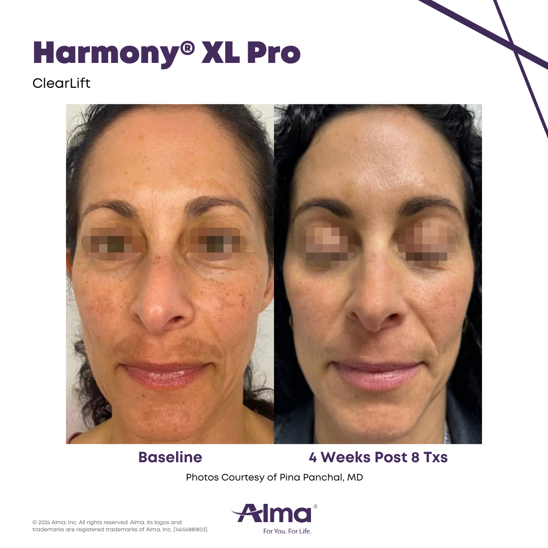 Before and after pigmentation reduction with the Alma Harmony XL Pro at APMUC, Orlando, Florida. Patient result courtesy of Pina Panchal, MD / Alma.