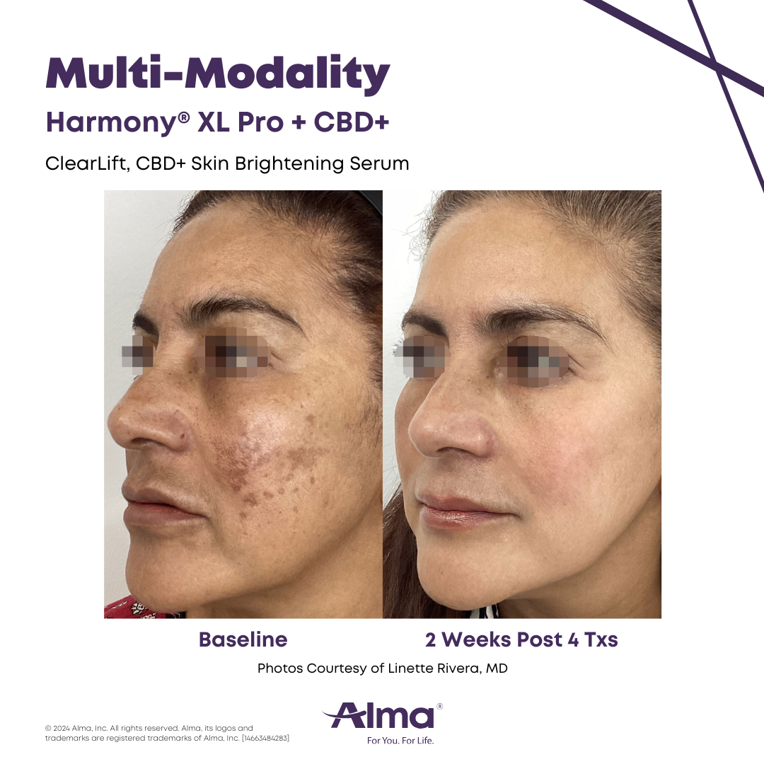 Before and after melasma treatment with the Alma Harmony XL Pro at APMUC, Orlando, Florida. Patient result courtesy of Linette Rivera, MD / Alma.