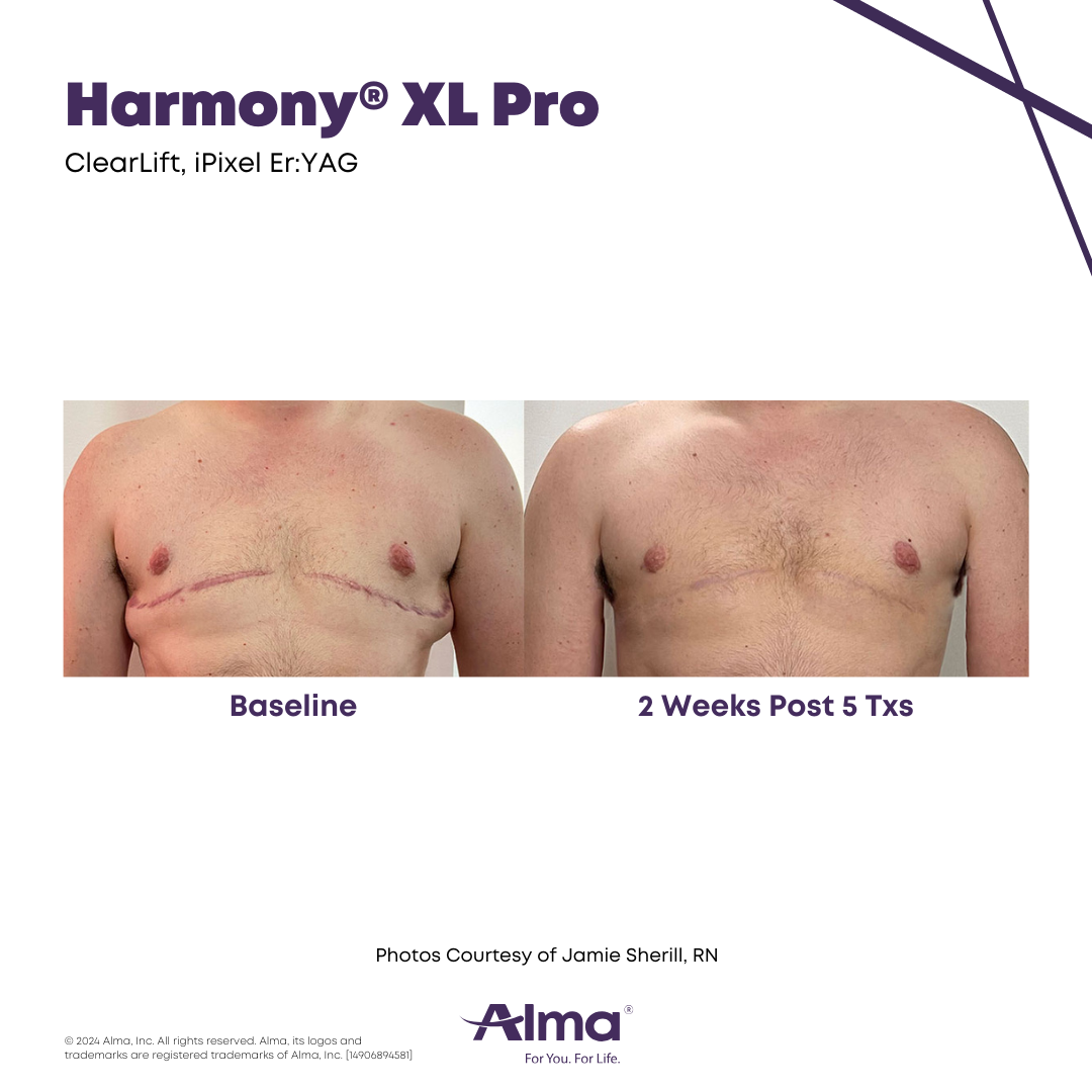 Before and after surgical scar revision with the Alma Harmony XL Pro at APMUC, Orlando, Florida. Patient result courtesy of Jamie Sherill, RN / Alma.
