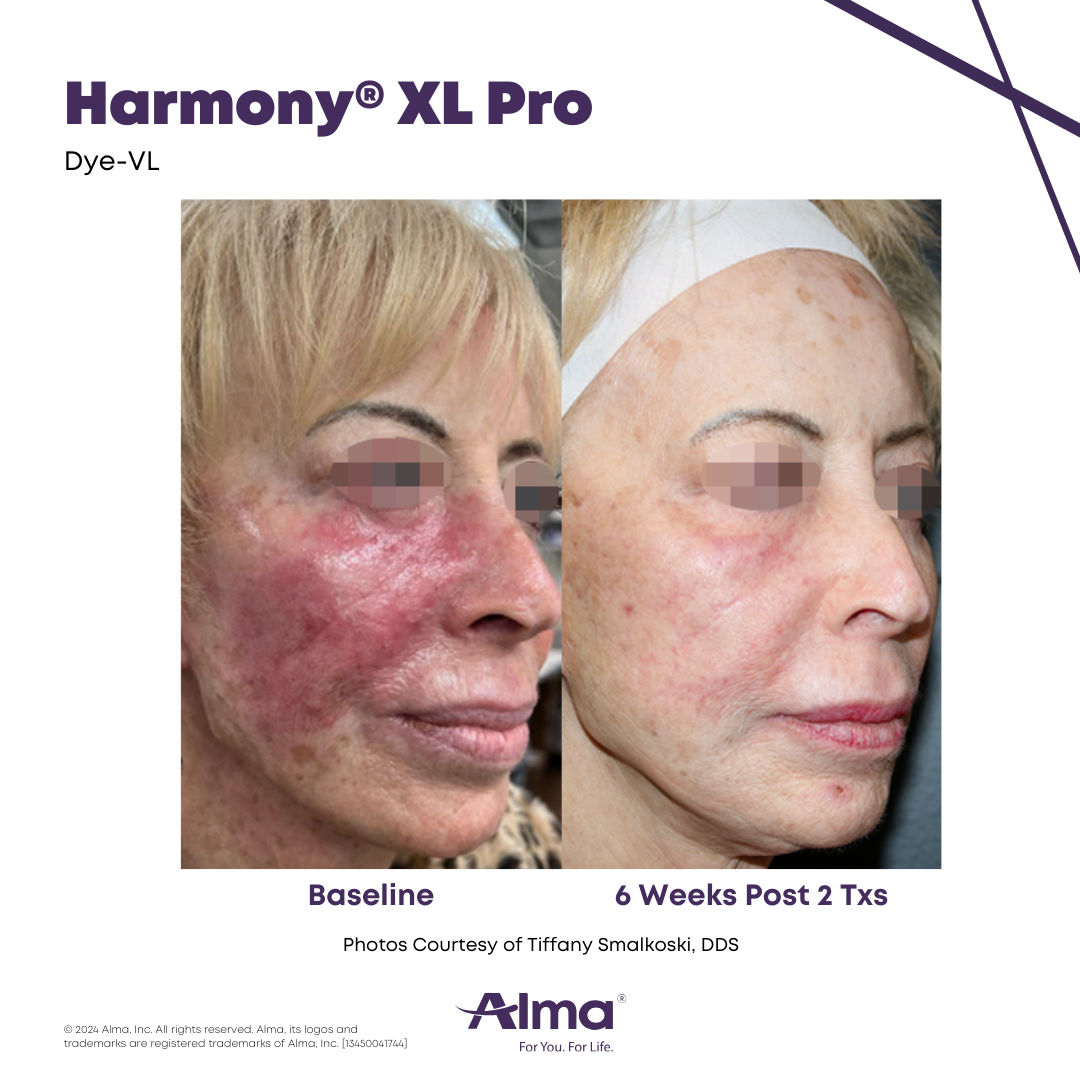 Before and after rosacea and facial redness reduction with the Alma Harmony XL Pro at APMUC, Orlando, Florida. Patient result courtesy of Tiffany Smalkoski, DDS / Alma.